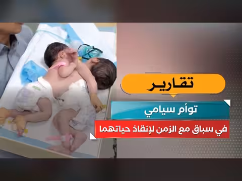 توأم سيامي في سباق لإنقاذ حياتهما في برنامج صدى الأسبوع