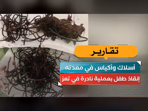 إنقاذ طفل بعملية نادرة بعد العثور على أسلاك وأكياس في معدته بتعز