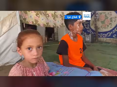 جدري الماء ينتشر بين نازحي غزة