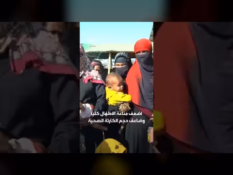 وزارة الصحة في بنغلادش تعلن وفاة ألف طفل بالحصبة