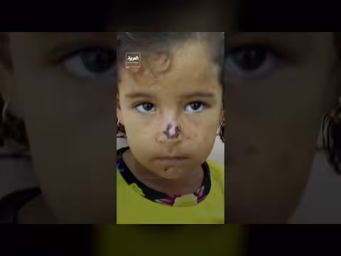 كارثة وبائية في غزة مع تفشي جدري الماء
