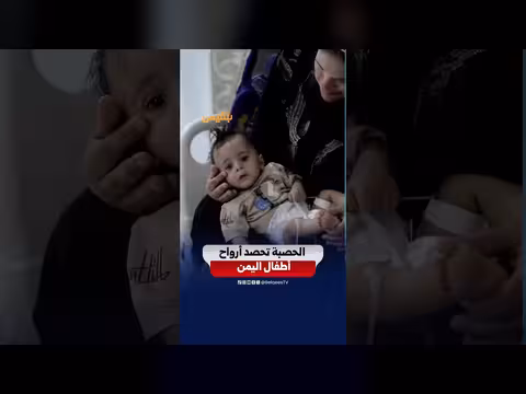 الحصبة تودي بحياة أطفال اليمن