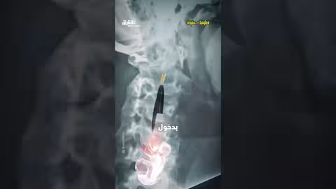 عيب في غطاء القلم: ثقب صغير