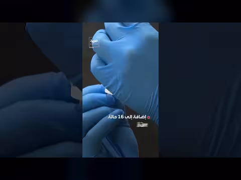 إصابات الحصبة في أميركا تتجاوز إجمالي العام الماضي